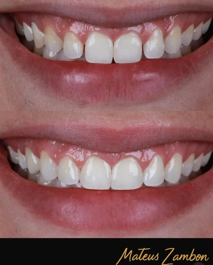 Antes e depois: fechamento de diastema