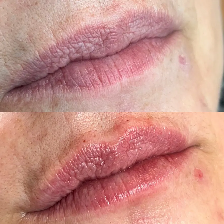 Antes e depois: preenchimento labial