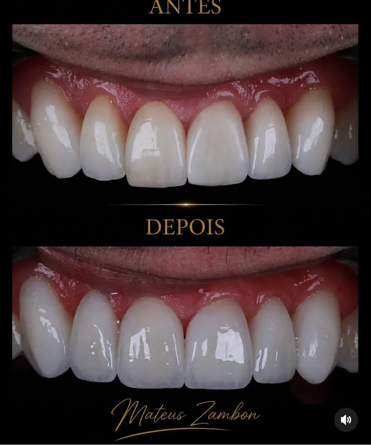 Antes e depois: lentes de porcelana