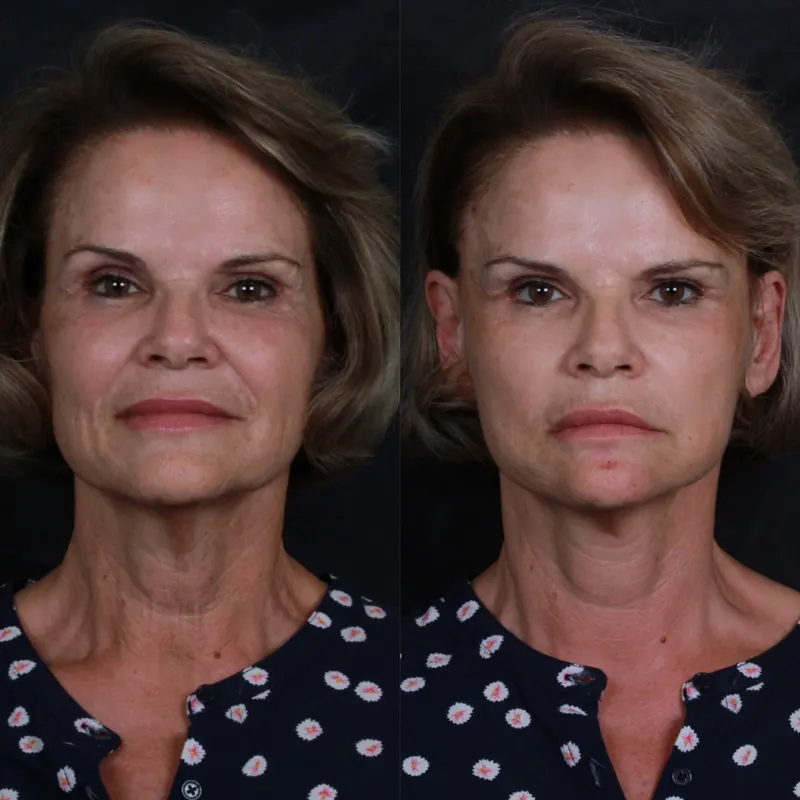 Antes e depois: lifting facial