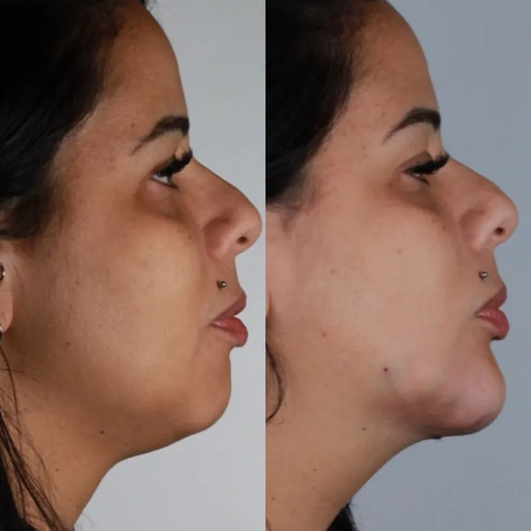 Antes e depois: lipo de papada