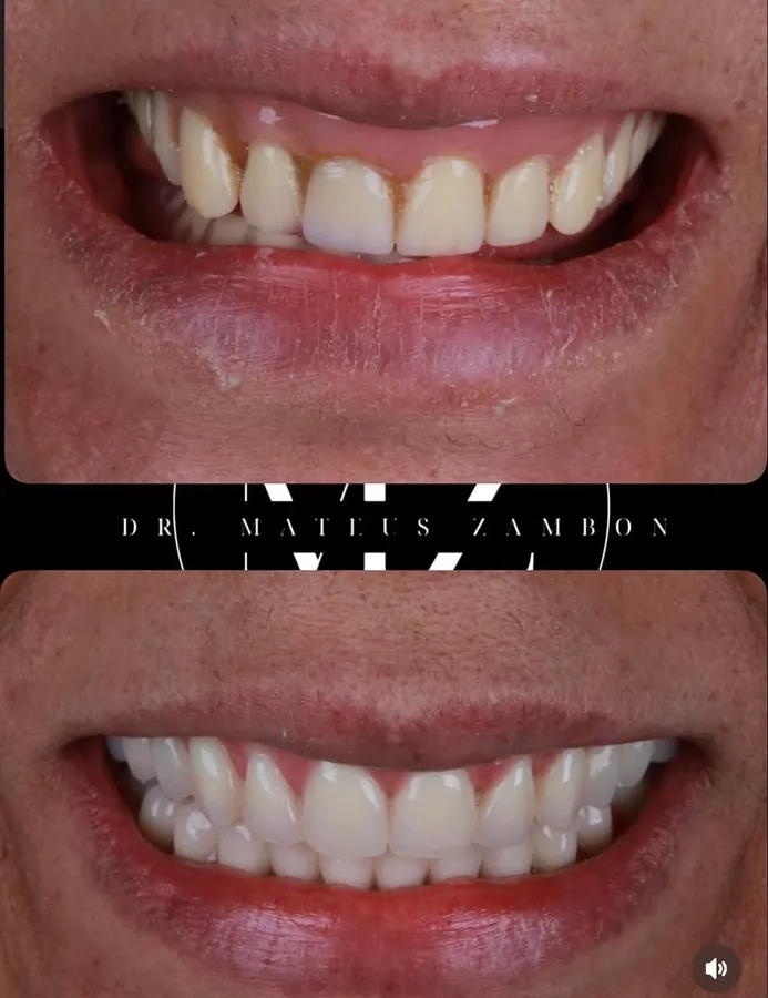 Antes e depois: prótese protocolo