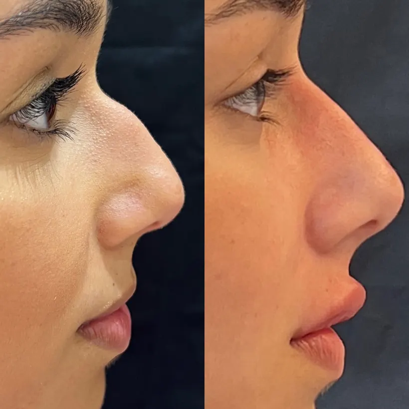 Antes e depois: rinomodelação