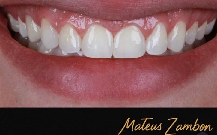 Depois: Fechamento de diastema
