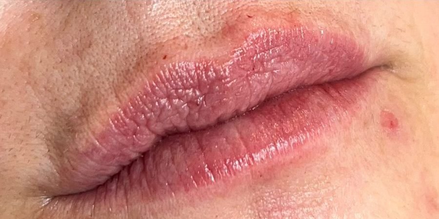 Depois: Preenchimento labial