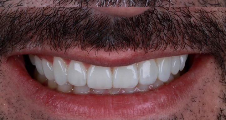 Depois: Lentes em resina